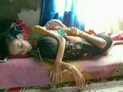 Butuh Uluran Tangan, Gadis Asal Bengkulu Ini Idap Tumor di Usus