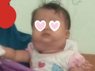 Didiagnosa Sakit Kelenjar Getah Bening, Bayi Berumur 11 Bulan di Seluma Butuh Uluran Tangan